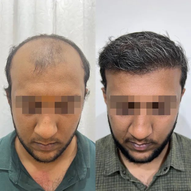 /hair-transplant-result-1.webp