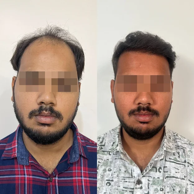 /hair-transplant-result-10.webp