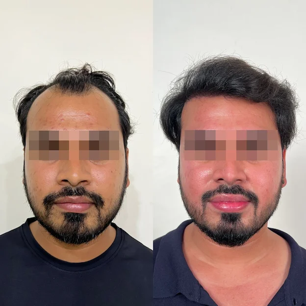 /hair-transplant-result-12.webp