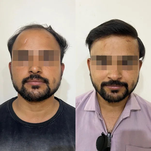 /hair-transplant-result-13.webp