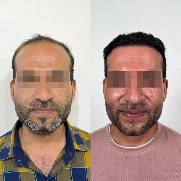 DermaQ Transplant Before After