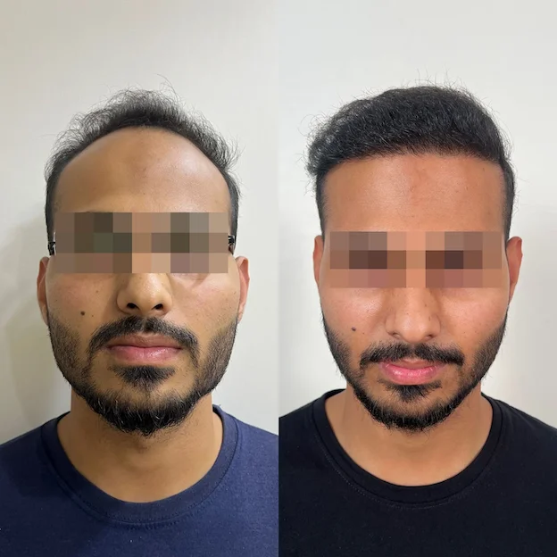 /hair-transplant-result-15.webp