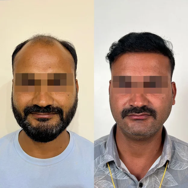 /hair-transplant-result-16.webp