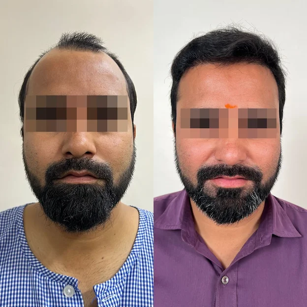 DermaQ Transplant Before After