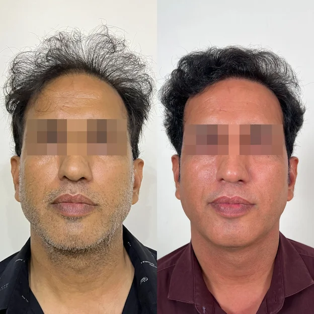 DermaQ Transplant Before After