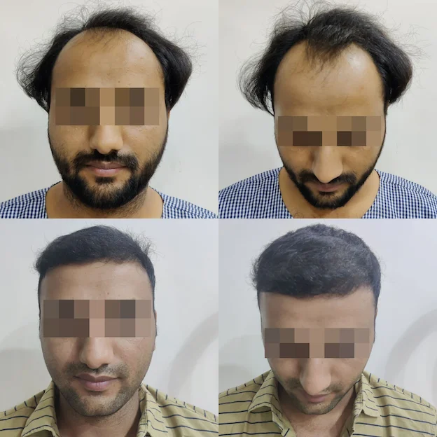 /hair-transplant-result-2.webp