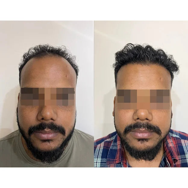 /hair-transplant-result-20.webp