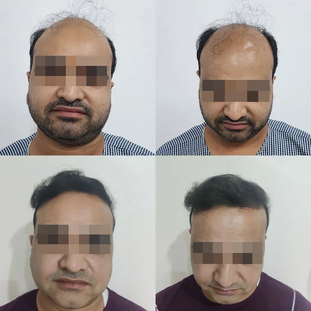 /hair-transplant-result-5.webp