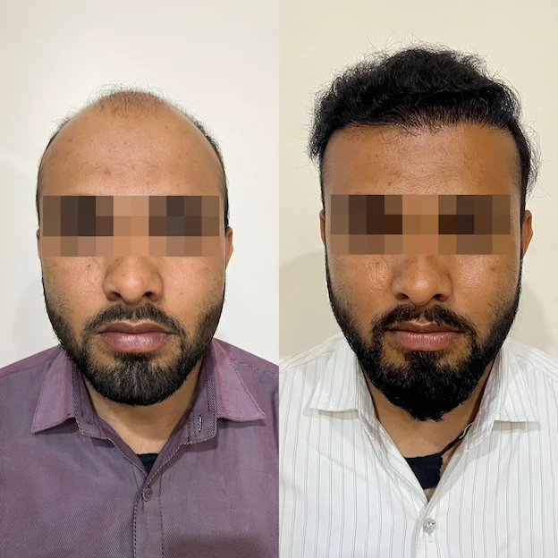 /hair-transplant-result-6.webp