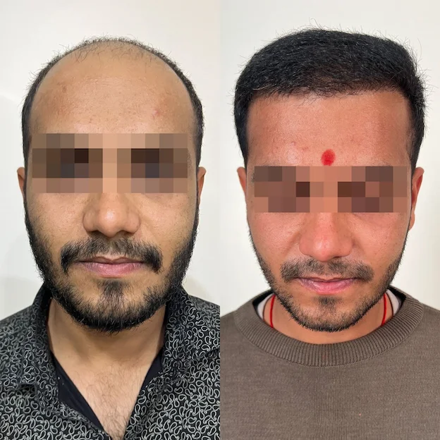 /hair-transplant-result-7.webp