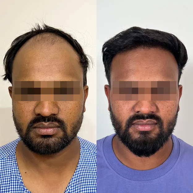 /hair-transplant-result-8.webp