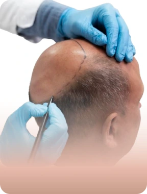 DermaQ Hair Transplant Success